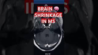 Brain  Shrinkage & Black Holes in Multiple Sclerosis