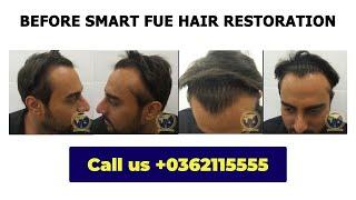 8 Months After SMART FUE Hair Restoration: Transformation | Glojas Aesthetic Clinic