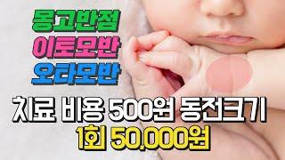 몽고반점 이토모반 오타모반 치료비용 / 500원 동전크기 피코레이저 시술 50000원/아기 반점 치료