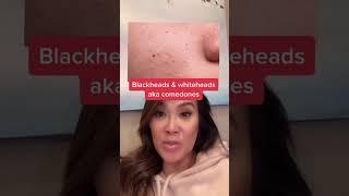 3 Major Types of Acne with Dr Pimple Popper