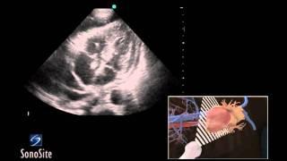 How To: Ultrasound Guided Pericardiocentesis Procedure 3D Video