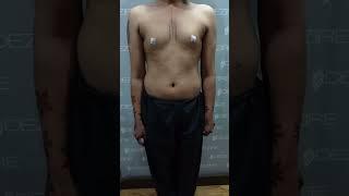 Silicone Breast implant Surgery | Breast augmentation surgery #shorts #ytshort