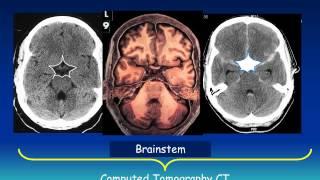 Acute Brain Imaging - The 3 Slice Method