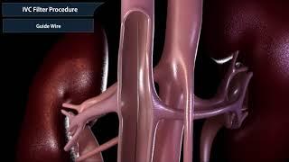 Inferior vena cava filter procedure