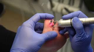 Wart Removal with K Laser Cube