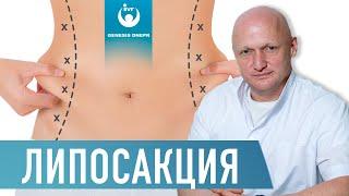 Что такое ЛИПОСАКЦИЯ? Лазерная липосакция, вибролипосакция, ультразвуковая липосакция.|Хирург Щевцов