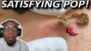 Unbelievable! Giant Back Cyst Sprays Everywhere! | Popping huge blackheads and Pimple Popping