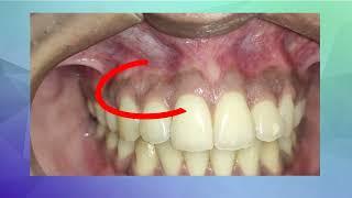 Examination of Gingival Stippling