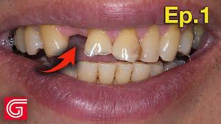 HOW TO Restore DENTAL Occlusion with Missing Tooth #7 | Ep 1