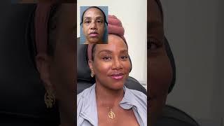 Patient Expected to Look 10 Years Younger… BUT I DOUBLED IT #fullfacerejuvenation #plasticsurgery