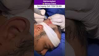 Hair transplant at skinaa clinic #hairtransplantsuccess #shorts