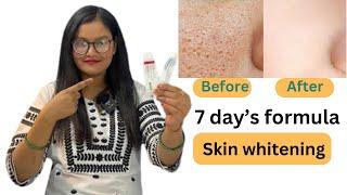 Best formula for pigmentation ,dark spots & whitening | I tried this formula 