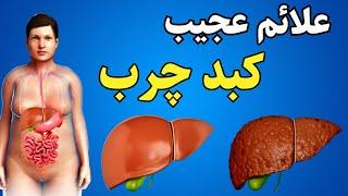 علائم کبد چرب | 7 علائمی که نشون میده شما کبد چرب دارید