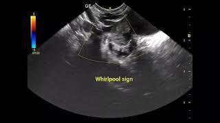 Ultrasound Shows Torsion of Paraovarian Cyst