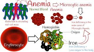 Iron deficiency anemia - Most Common anemia.  Microcytic  anemia symptoms and treatment