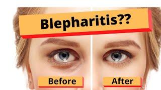 Blepharitis.  How to treat Blepharitis. Best Home Treatment.