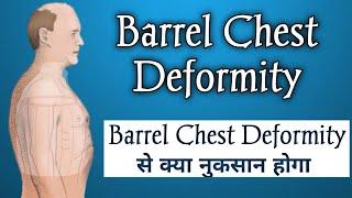 Barrel Chest | Chest Deformity Simplified | Barrel Chest Breathing