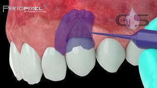 3D dental video - PeriAcryl 90 in muccogingival surgery