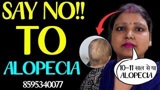 Powerful Alopecia Areata Treatment | Regrow Your Hair Obviously with Dr. Bansal