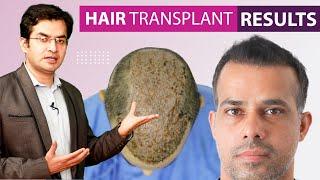 Hair Transplant Before and After Results Grade 6 | 5000 Grafts at Medispa | Dr Suneet Soni