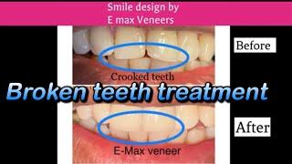 How Broken / chipped teeth are repaired with E-max veneer ? Smile improvement