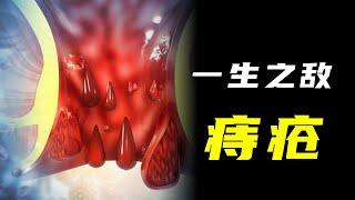 被稱為「一生之敵」的痔瘡是如何冒出來的？看看你的痔瘡屬於哪種級別？【颀思诺想】