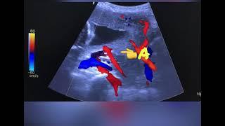 Identifying uterine artery in second trimestee