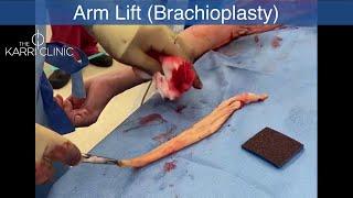 LIVE SURGERY | Brachioplasty (arm lift) | The Karri Clinic | Mr Vasu Karri