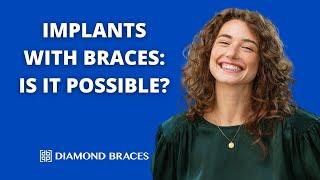 Can I Get an Implant With Braces?