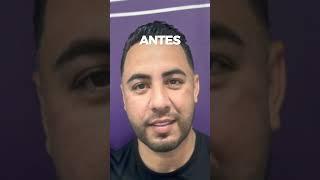 RINOPLASTIA - DR. CARLOS GAMBOA