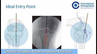 Tibia Nailing by Exemplary Trauma Surgeon Dr.Shailesh Pai - Conceptual Orthopedics