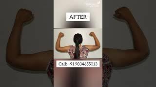 VASER Liposuction for stubborn fat in Pune