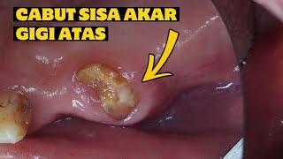 CABUT GIGI | SISA AKAR GIGI | PENCABUTAN GIGI ATAS | Dentist | Dokter Gigi Tri Putra