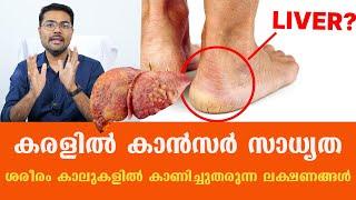 Symptoms of Liver Cancer in Legs / Dr Manoj Johnson