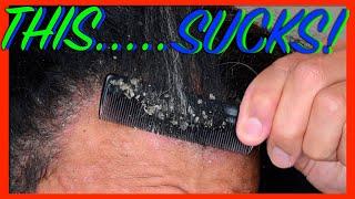 THIS IS GETTING REALLY OLD | DANDRUFF FLAKES | SEBORRHEIC DERMATITIS | PitaFlakes