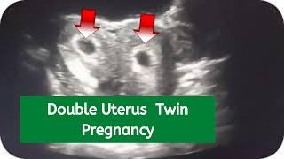 Double Uterus Twin Pregnancy | bicornuate | 6-7 weeks