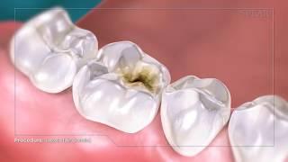 Composite Fillings