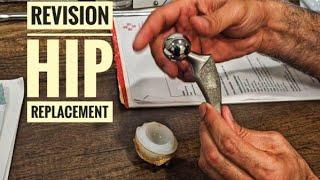 Revision Hip Replacement: Why it happens ?