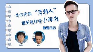 澳門地區去哪植髮比較好？珠海雍禾植髮怎麼樣？Yonghe hair transplant