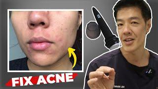 Getting Rid of Acne Scars at Home : Microneedling | Dr Davin Lim