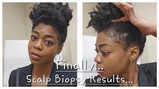 Scalp Biopsy Results, Treatment Options, & Venting! - 4C Natural Hair - Hair Loss