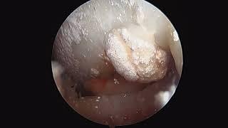 Gout of the Left Knee Joint