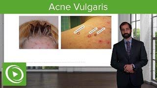 Inflammatory Skin Diseases: Acne Vulgaris – Pathology | Lecturio