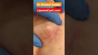 the largest chest wall cysr #shorts #blackheads #drkhaledsadek #cystremoval Dr Khaled Sadek