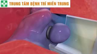 Điều Trị Bệnh Trĩ Bằng Cách Thắt Búi Trĩ | Trung Tâm Bệnh Trĩ Đà Nẵng | Khamtri.net