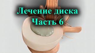 Правильное лечение межпозвоночной грыжи. Стволовые клетки, факторы роста, дискогенная боль. Ч 6