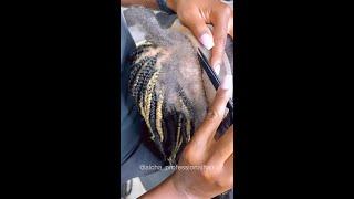 Alopecia Frontal Braids 1