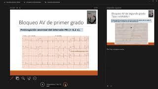 BLOQUEOS AV Y ARRITMIAS SUPRAVENTRICULARES VIDEOCONFERENCIA