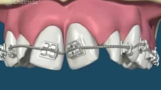 Ортодонтия  Брекеты  Выравнивание зубов