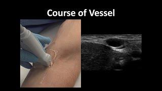 Ultrasound-Guided Peripheral Vascular Access -- BAVLS